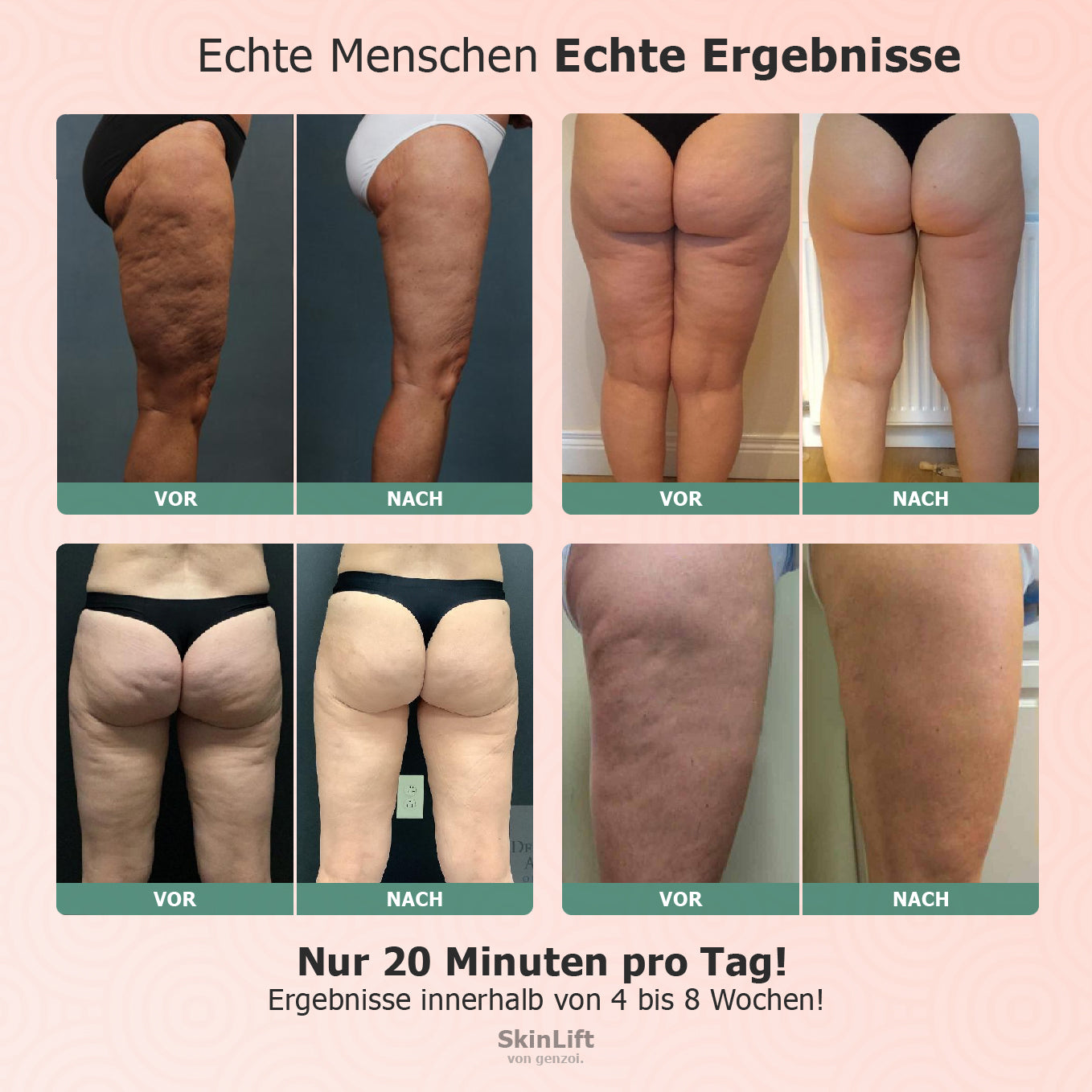 SkinLift™ - Fortgeschrittene Cellulite & Hautstraffung
