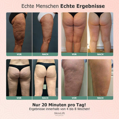 SkinLift™ - Fortgeschrittene Cellulite & Hautstraffung